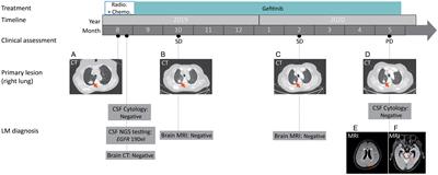 Case report: Cerebrospinal fluid-derived circulating tumor DNA diagnoses and guides the treatment of a lung adenocarcinoma case with leptomeningeal metastasis